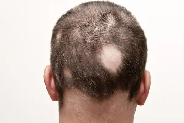 Alopecia aerata