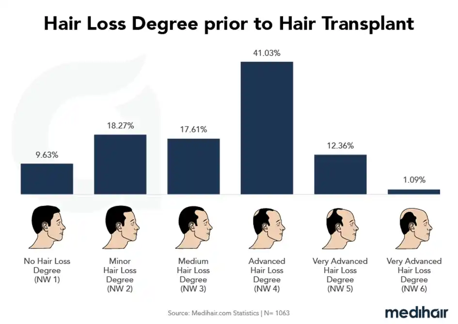 Degré de perte de cheveux homme avant greffe