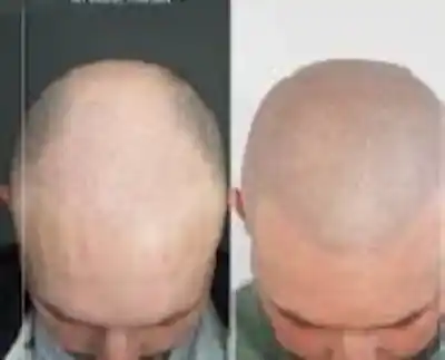 Trichopigmentation Effet crâne rasé homme