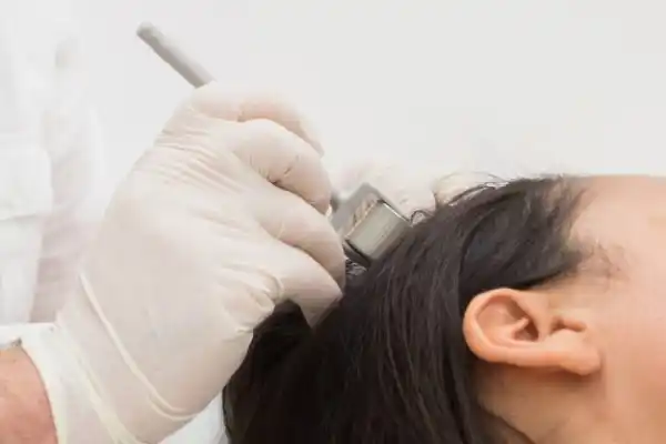 Séance de microneedling capillaire