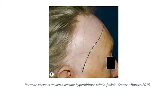 Perte de cheveux en lien avec une hyperhidrose cranio-faciale. Source : Harries 2015