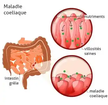 Maladie de coeliaque : Villosités intestinales détruites par le gluten