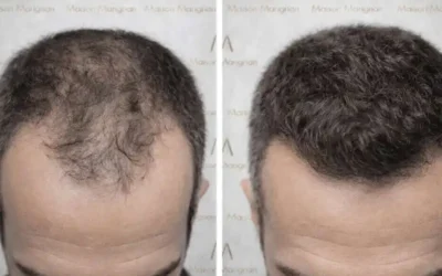 Chute de cheveux : quand approches naturelles et solutions chirurgicales se complètent