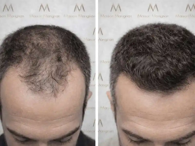 Chute de cheveux : quand approches naturelles et solutions chirurgicales se complètent